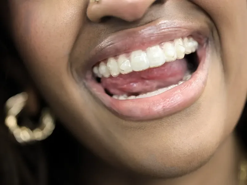 Close-up of a patient's smile with a gold hoop earring